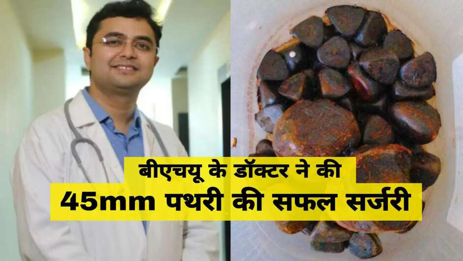 डॉ. यश पांडे ने बीएचयू में अब तक की सबसे बड़ी 45 एमएम स्टोन की सफल सर्जरी की